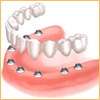 Одномоментная имплантация всех зубов