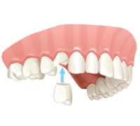 Восстановление одного зуба