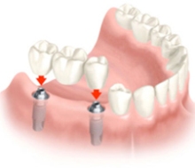 Крепление мостовидных протезов